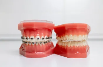 Brackets und Aligner